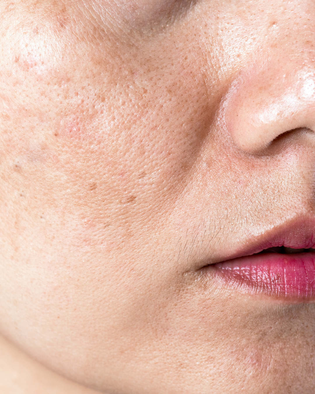 Dark Spot & Pigmentation